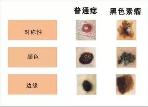 老二長痣|哪種痣是致死率超高的「索命痣」？5 大關鍵辨別癌病。